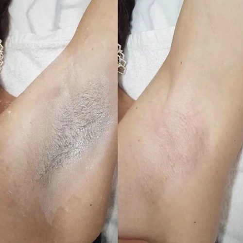 Resultado con DEPILACT